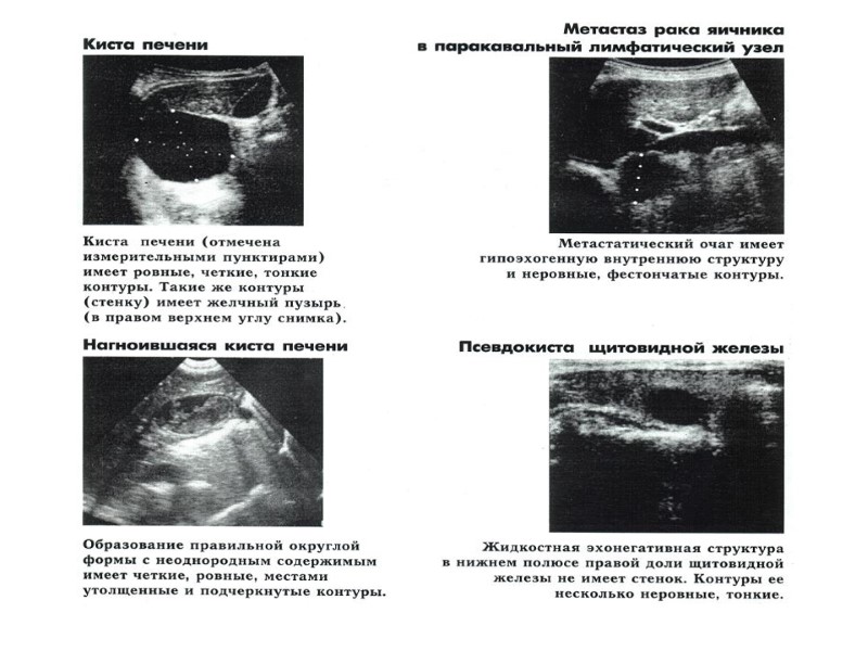 ВАРИАНТЫ КОНТУРОВ ОЧАГОВОЙ ЗОНЫ